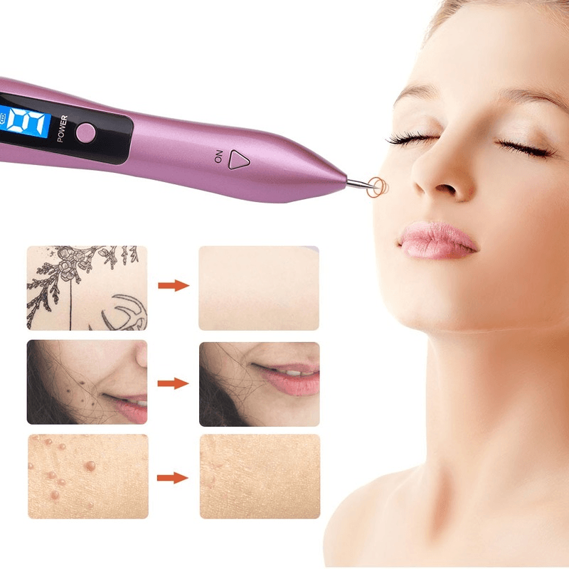 Laser Plasma Pen Blemish Remover - Home Usage Beauty Equipment Safe & Effective